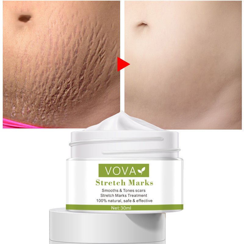 Anti-Stretch Marks Scar Removal Cream