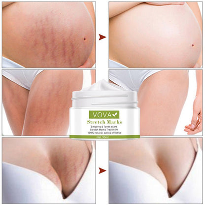 Anti-Stretch Marks Scar Removal Cream